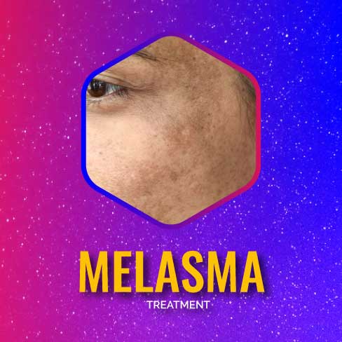 Melasma