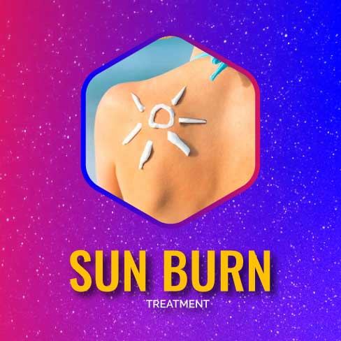 Sun-Burn3